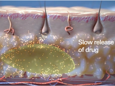 Initial Burst of the API into the body from the FluidCrystal lipid lamellar structure